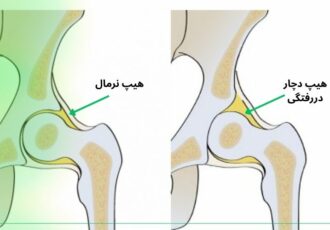 درمان خانگی دررفتگی لگن ممکن است؟