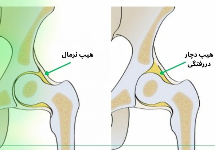 درمان خانگی دررفتگی لگن ممکن است؟