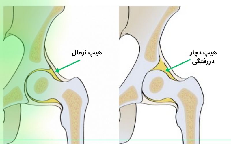 درمان خانگی دررفتگی لگن ممکن است؟ درمان خانگی دررفتگی لگن ممکن است؟