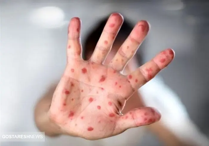 هشدار بیماری | اتباع افغان و پاکستان سوغاتی تازه آوردند ! هشدار بیماری | اتباع افغان و پاکستان سوغاتی تازه آوردند !