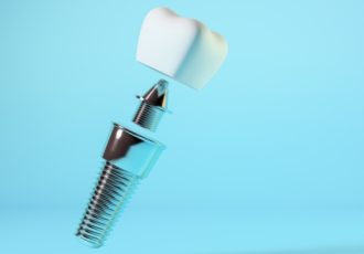 نقش کلیدی اباتمنت در موفقیت ایمپلنت‌های دندانی