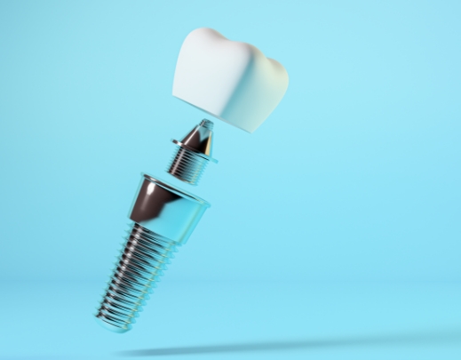 نقش کلیدی اباتمنت در موفقیت ایمپلنتهای دندانی نقش کلیدی اباتمنت در موفقیت ایمپلنتهای دندانی