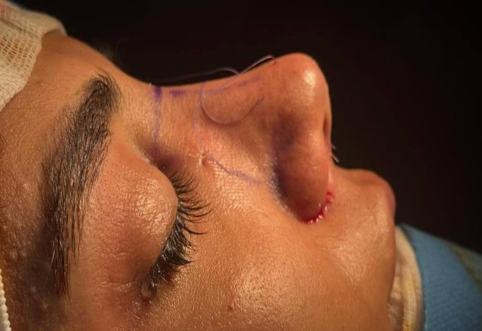 تغییر چهره بدون از دست دادن زیبایی طبیعی با عمل رینوپلاستی تغییر چهره بدون از دست دادن زیبایی طبیعی با عمل رینوپلاستی