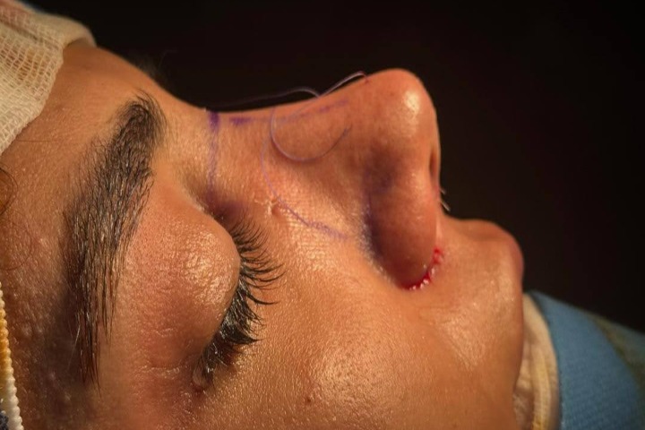 تغییر چهره بدون از دست دادن زیبایی طبیعی با عمل رینوپلاستی