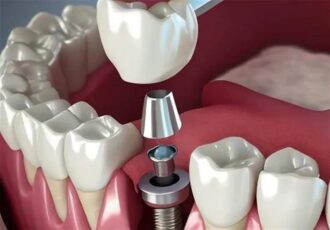 تبلیغ ایمپلنت فوری دروغ است/سلبریتی‌ها حق تبلیغ خدمات پزشکی را ندارند