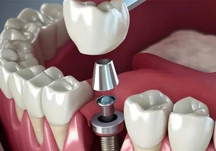 تبلیغ ایمپلنت فوری دروغ است/سلبریتیها حق تبلیغ خدمات پزشکی را ندارند تبلیغ ایمپلنت فوری دروغ است/سلبریتیها حق تبلیغ خدمات پزشکی را ندارند